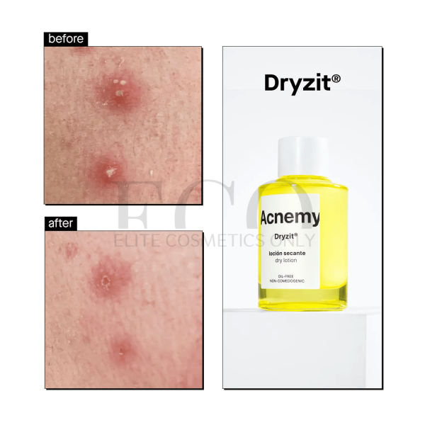Підсушуючий точковий лосьон від прищів Acnemy Dryzit, 30 мл