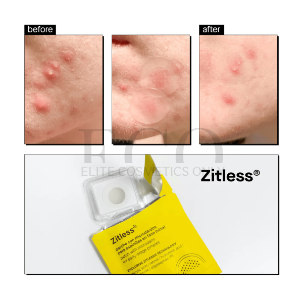 Acnemy Zitless Microneedle patch for early stages of acne, 5 pcs