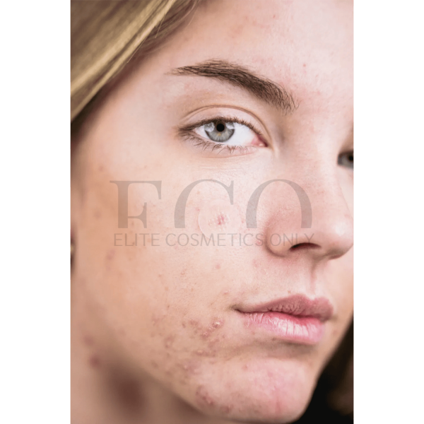 Acnemy Zitless Microneedle patch for early stages of acne, 5 pcs